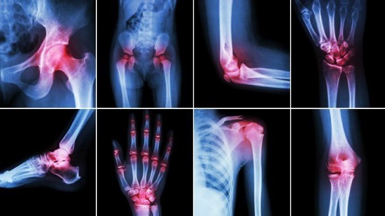 Artritické bolesti a zánět se mohou projevit v kterémkoliv kloubů těla; zdroj: everydayhealth.com